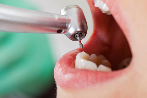 Best Dentist for Tooth Abscess  in Pimmit Hills, VA